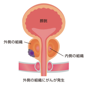 前立腺癌