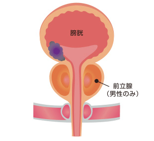 膀胱癌（尿路上皮癌）