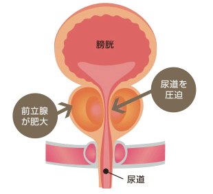 前立腺肥大症