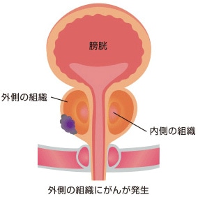 前立腺癌イメージ