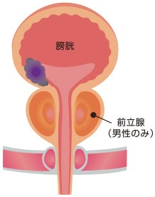 尿路上皮癌イメージ