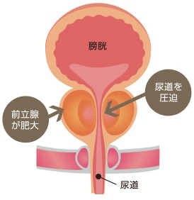 前立腺肥大症イメージ