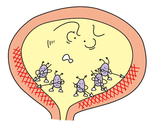 膀胱炎イメージ