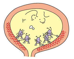 膀胱炎
